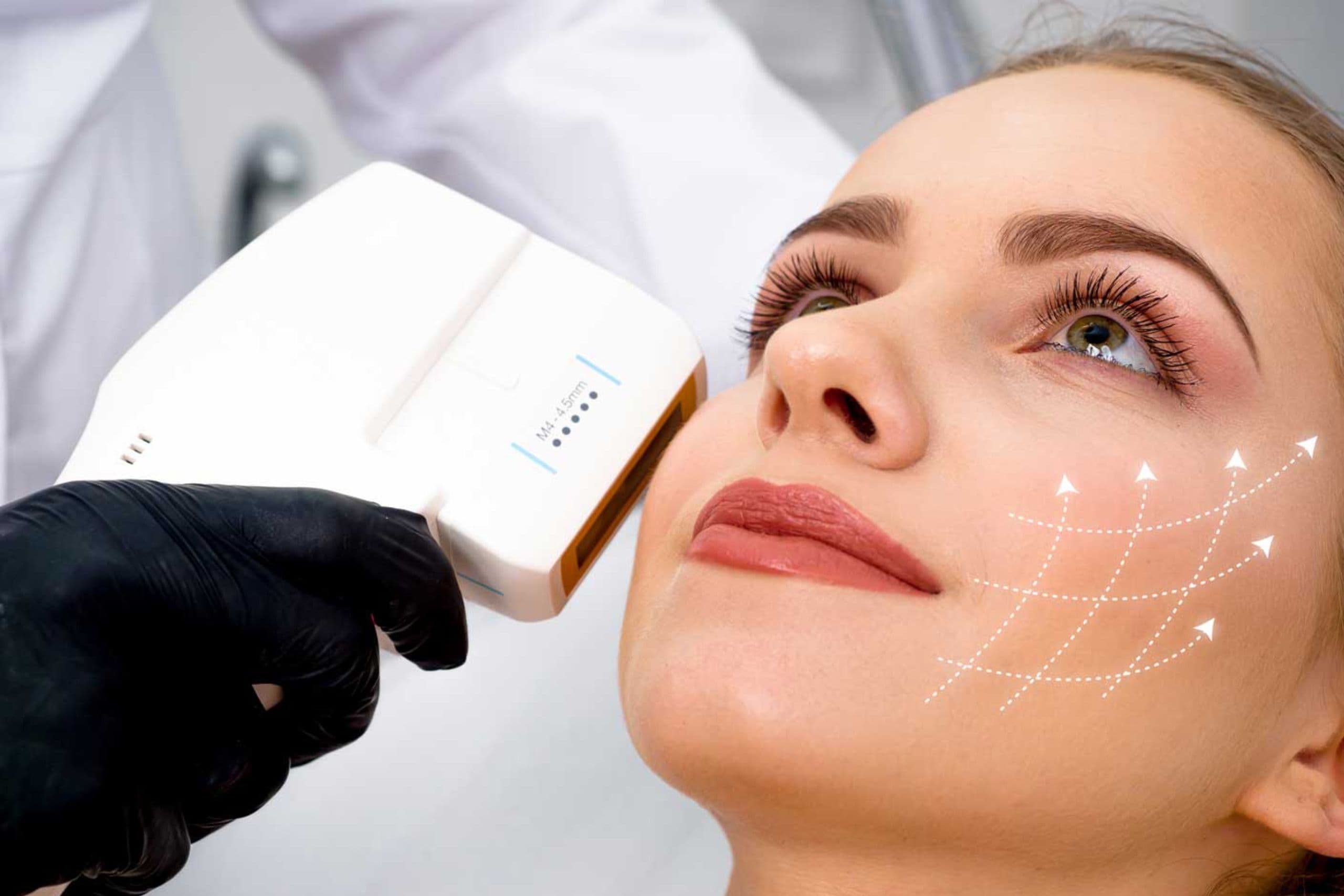 HIFU skin tightening treatment being performed on a client at e-skin